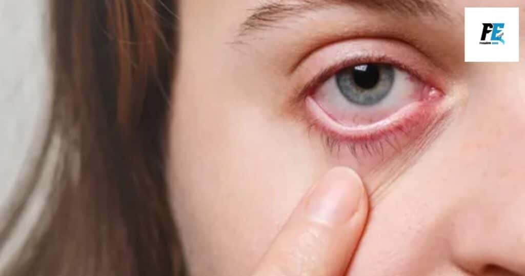 Allergic Conjunctivitis