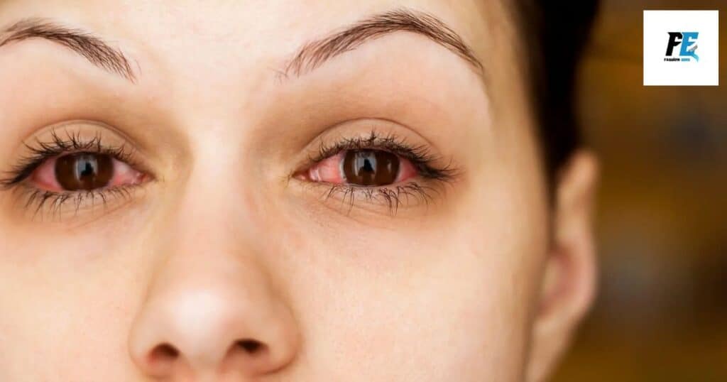 Bacterial Conjunctivitis