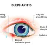 Blepharitis from Eyelash Extensions - The Most Common Eye Infection