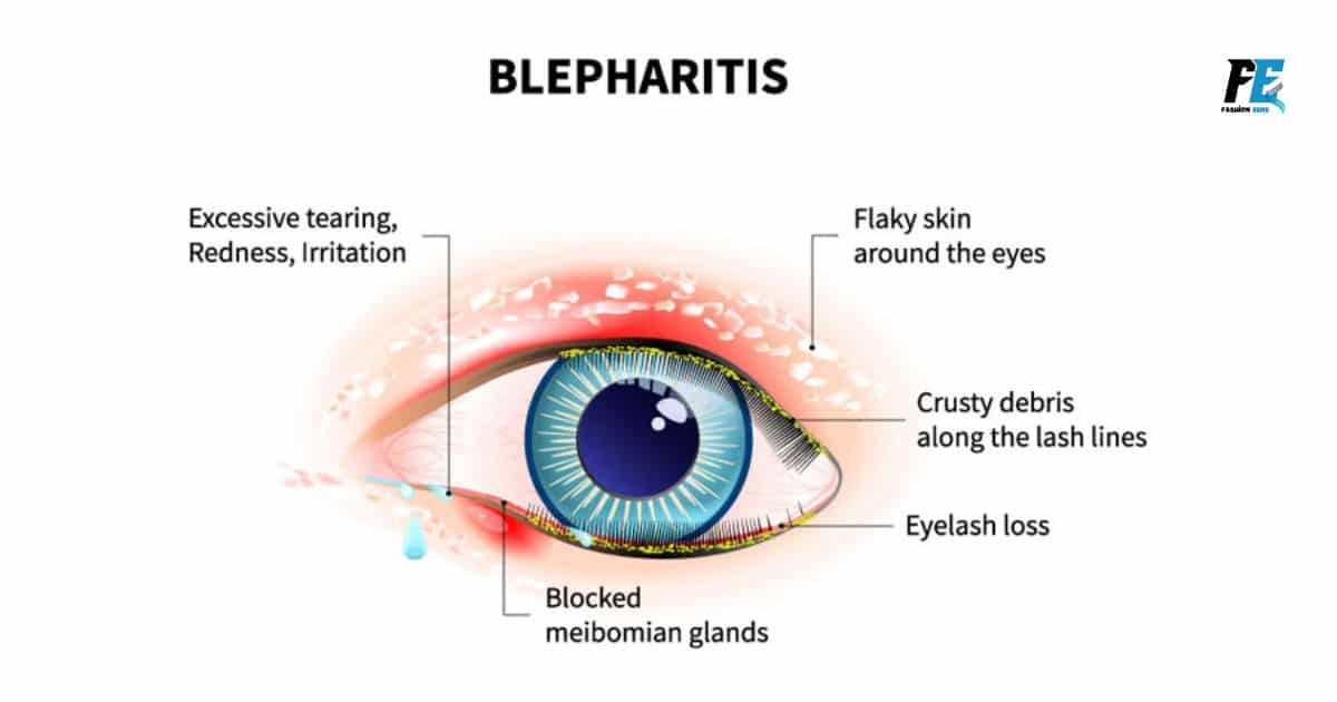 Blepharitis from Eyelash Extensions - The Most Common Eye Infection