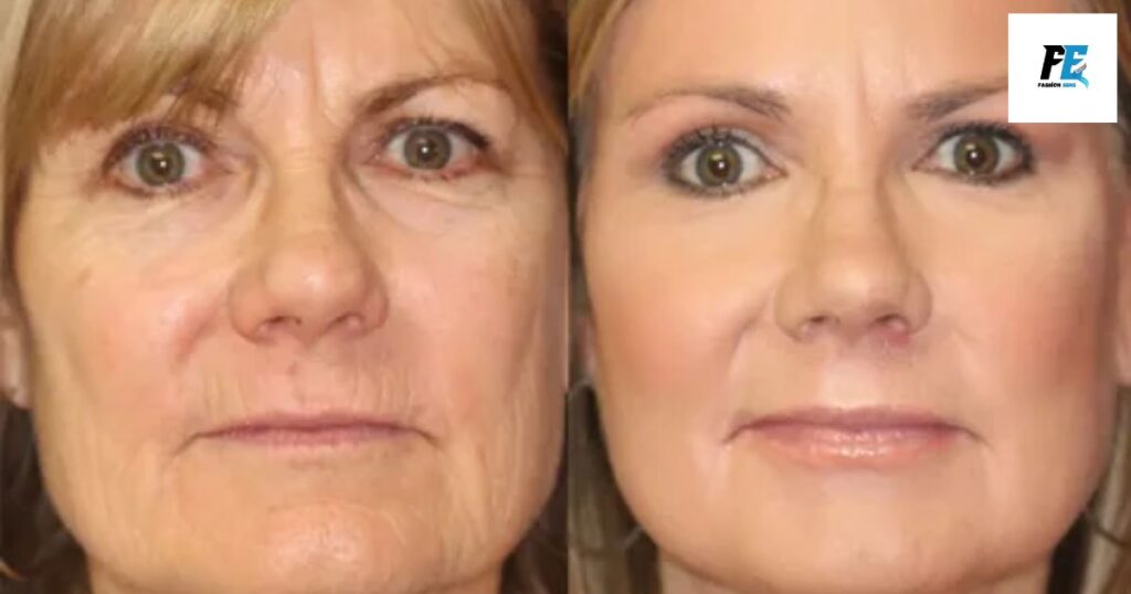 Actual Results – Full Face Fibroblast Before and After Procedure