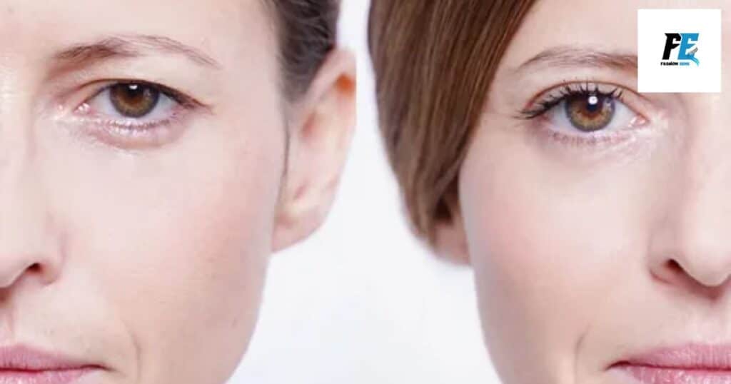 Benefits of HIFU Eye Lift: A Youthful Look Without Surgery