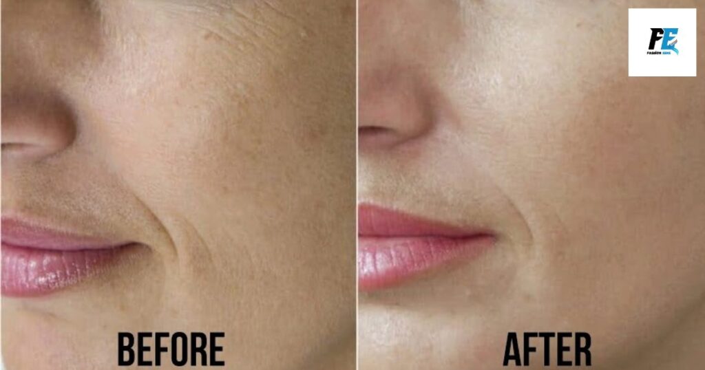 Noseplasma fibroblasting before and after