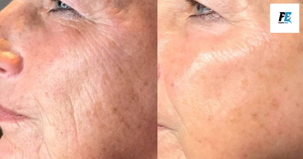 Plasma Fibroblast Before and After for Face Skin