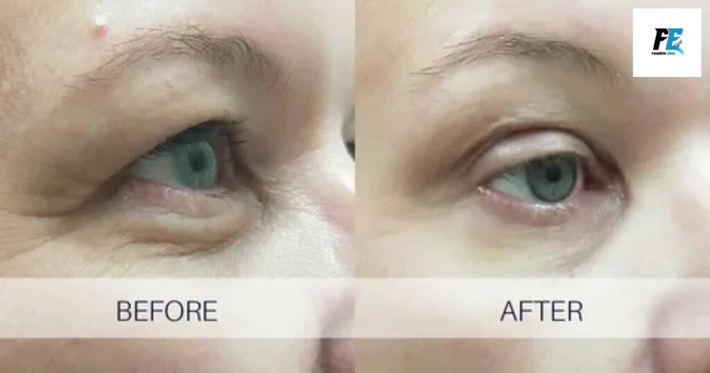 Plasma eye lift before and after